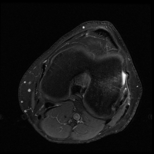 File:ACL and meniscal tears (Radiopaedia 79604-92797 Axial PD fat sat 14).jpg