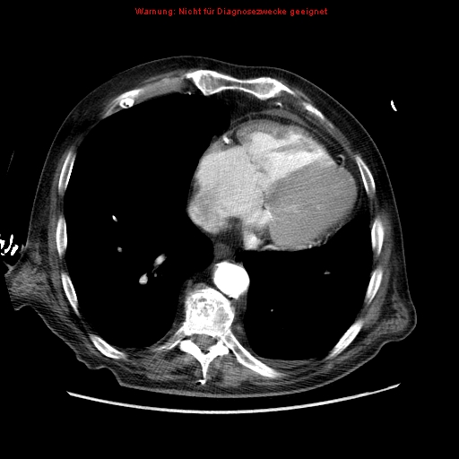 Abdominal aortic aneurysm- extremely large, ruptured (Radiopaedia 19882-19921 Axial C+ arterial phase 3).jpg