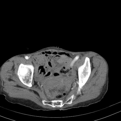 File:Abdominal aortic aneurysm (Radiopaedia 20827-20742 Axial C+ arterial phase 34).jpg