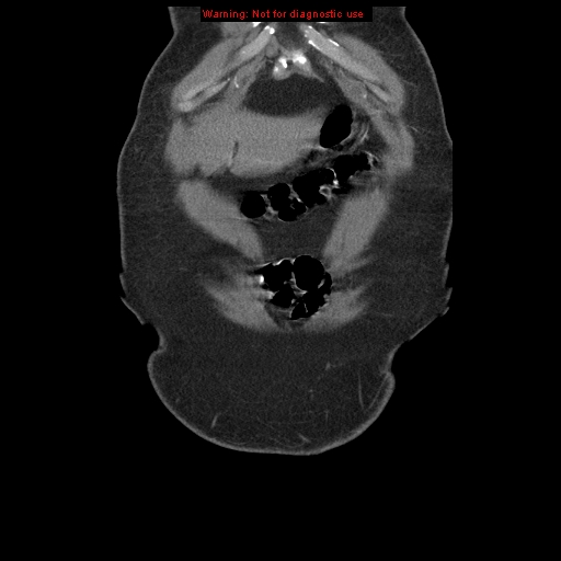 Abdominal aortic aneurysm (Radiopaedia 8190-9038 Coronal C+ arterial phase 11).jpg