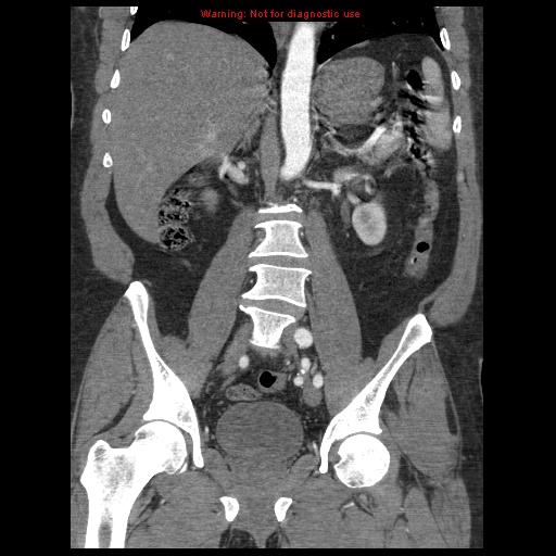 Abdominal aortic aneurysm (Radiopaedia 8190-9038 Coronal C+ arterial phase 74).jpg
