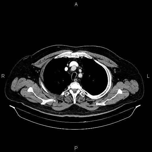 Abdominal aortic aneurysm (Radiopaedia 83094-97462 Axial renal cortical phase 17).jpg