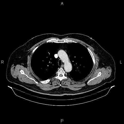 Abdominal aortic aneurysm (Radiopaedia 83094-97462 Axial renal cortical phase 25).jpg