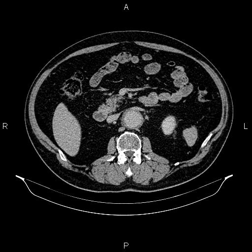 Abdominal aortic aneurysm (Radiopaedia 83094-97462 Axial renal excretory phase 44).jpg