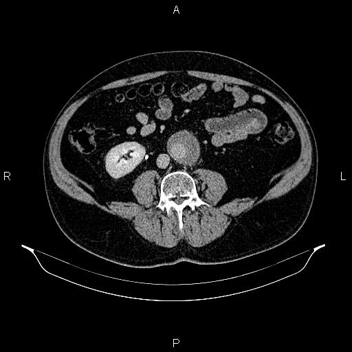 Abdominal aortic aneurysm (Radiopaedia 83094-97462 Axial renal excretory phase 64).jpg