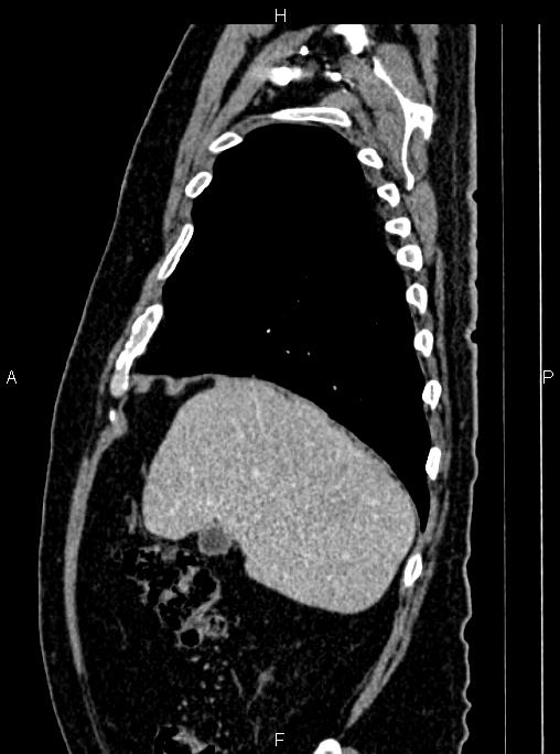 Abdominal aortic aneurysm (Radiopaedia 83094-97462 Sagittal renal cortical phase 28).jpg