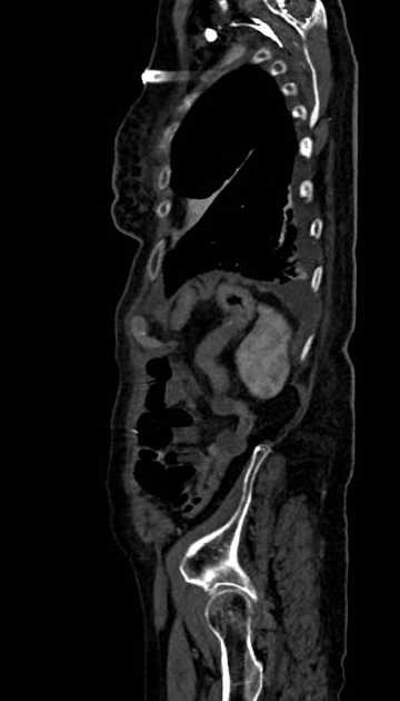 Abdominal aortic aneurysm with thrombus fissuration (Radiopaedia 73192-83919 Sagittal C+ arterial phase 15).jpg