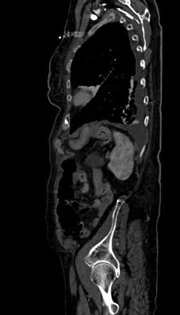 Abdominal aortic aneurysm with thrombus fissuration (Radiopaedia 73192-83919 Sagittal C+ arterial phase 19).jpg