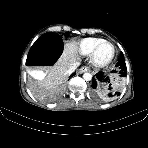 File:Abdominal collection due to previous cecal perforation (Radiopaedia 80831-94320 Axial C+ portal venous phase 21).jpg