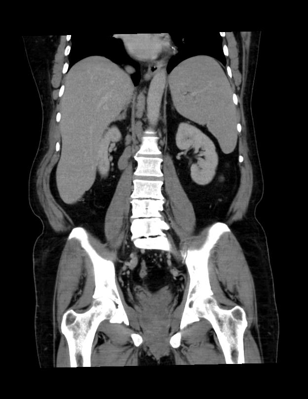 Abdominal lymphoma - with sandwich sign (Radiopaedia 53486-59492 C+ portal venous phase 22).jpg