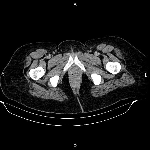 File:Abdominal lymphoma with sandwich sign (Radiopaedia 84378-99704 Axial C+ portal venous phase 61).jpg