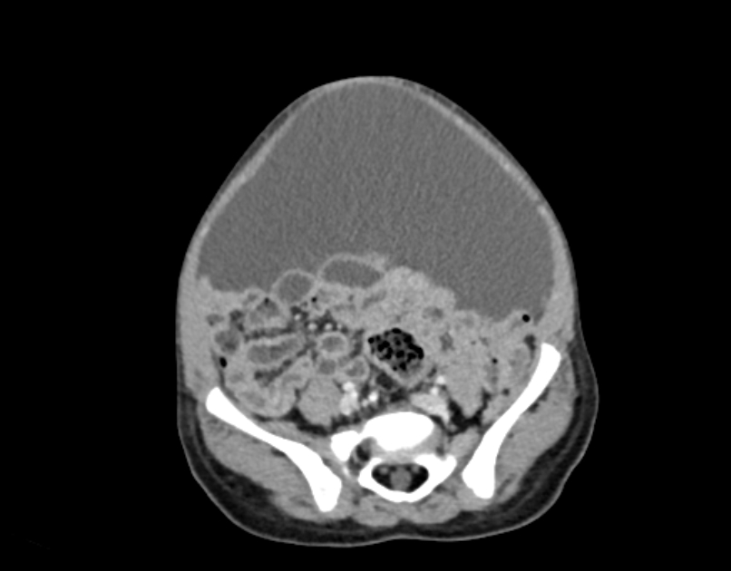 Abdominal premesenteric cystic lymphangioma (Radiopaedia 82995-97350 Axial C+ portal venous phase 48).jpg