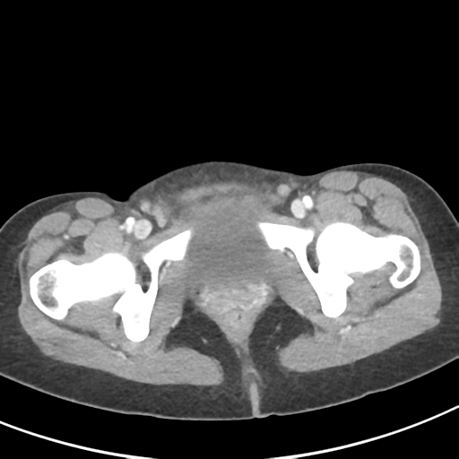 File:Abdominal tuberculosis and appendicitis (Radiopaedia 65631-74735 Axial C+ portal venous phase 69).png
