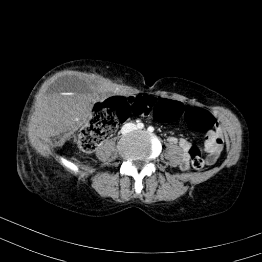 File:Abdominal wall hematoma with active bleeding (Radiopaedia 83915-99117 Axial C+ portal venous phase 67).jpg