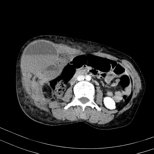 Abdominal wall hematoma with active bleeding (Radiopaedia 83915-99122 Axial contrast-enhanced CT 20).jpg