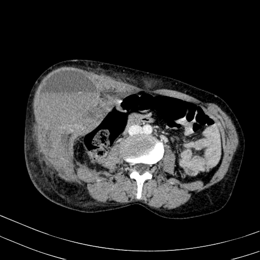 File:Abdominal wall hematoma with active bleeding (Radiopaedia 83915-99122 Axial contrast-enhanced CT 25).jpg