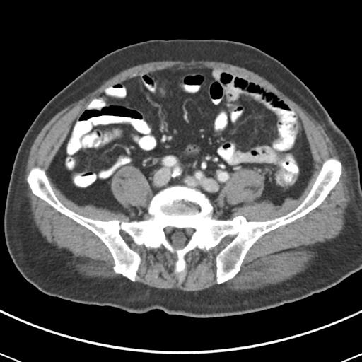 Abdominal wall metastasis from colorectal carcinoma (Radiopaedia 31016-31717 Axial C+ portal venous phase 52).jpg