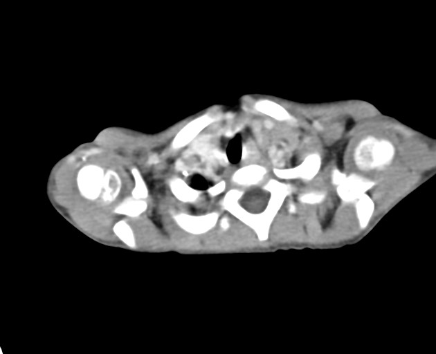 Abdominopelvic rhabdomyosarcoma (Radiopaedia 78356-90984 Axial C+ portal venous phase 1).jpg