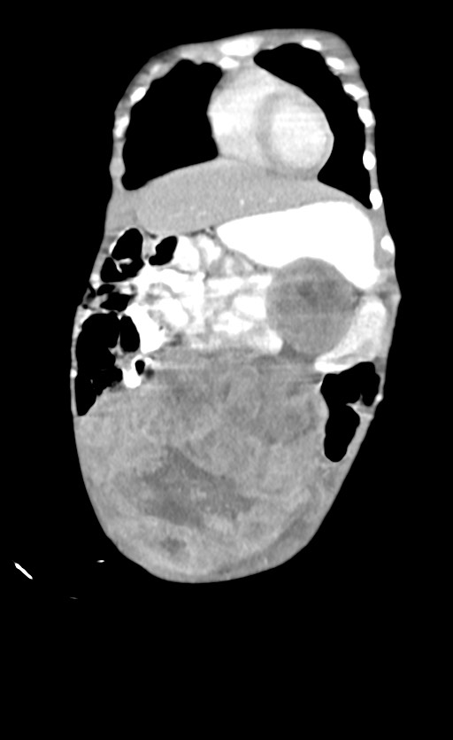 Abdominopelvic rhabdomyosarcoma (Radiopaedia 78356-90984 Coronal C+ portal venous phase 19).jpg