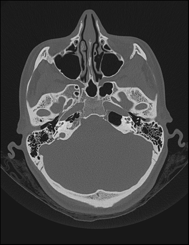 Aberrant right internal carotid artery (Radiopaedia 65191-74198 Axial non-contrast 41).jpg