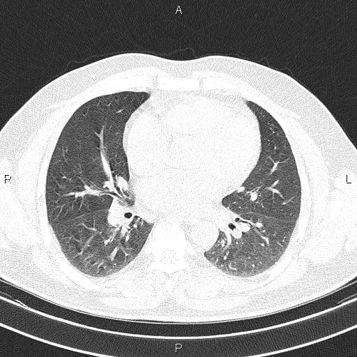 File:Aberrant right subclavian artery (Radiopaedia 87093-103354 Axial lung window 62).jpg