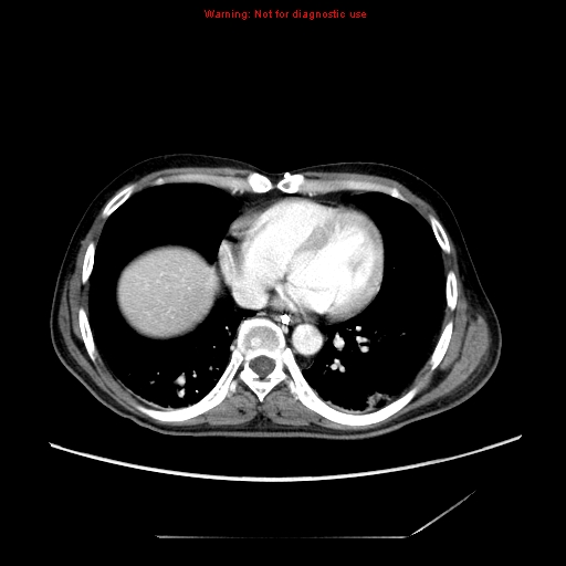 Aberrant right subclavian artery (Radiopaedia 9379-10071 Axial C+ arterial phase 44).jpg