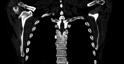 Accesory rib joint (Radiopaedia 71987-82452 Coronal bone window 49).jpg