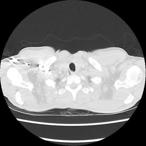 Accessory left horizontal fissure with lingular pneumonia (Radiopaedia 53763-59843 Axial lung window 5).jpg