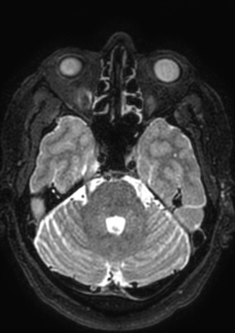 Accessory middle cerebral artery (Radiopaedia 73114-83828 Axial T2 151).jpg