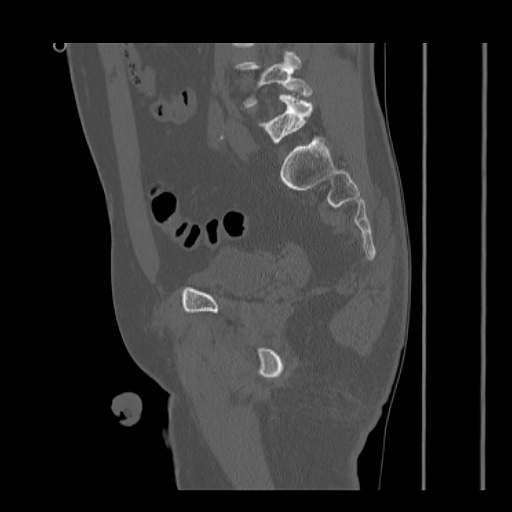 File:Acetabular and ilial fractures (Radiopaedia 59084-66378 Sagittal bone window 61).jpg