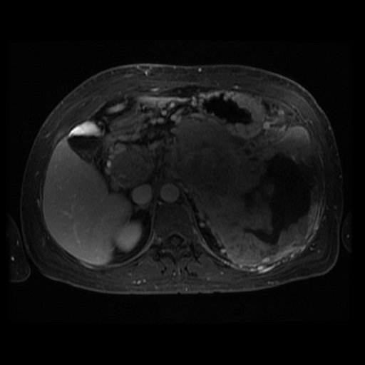 Acinar cell carcinoma of the pancreas (Radiopaedia 75442-86668 D 74).jpg