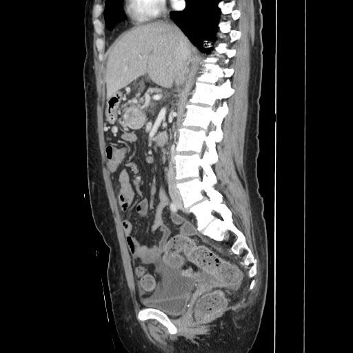Acinar cell carcinoma of the pancreas (Radiopaedia 75442-86669 Sagittal C+ portal venous phase 90).jpg