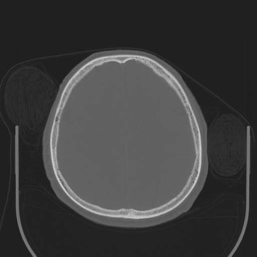 File:Acoustic schwannoma (Radiopaedia 29488-29982 AXIAL BONE THICK non-contrast 36).jpg