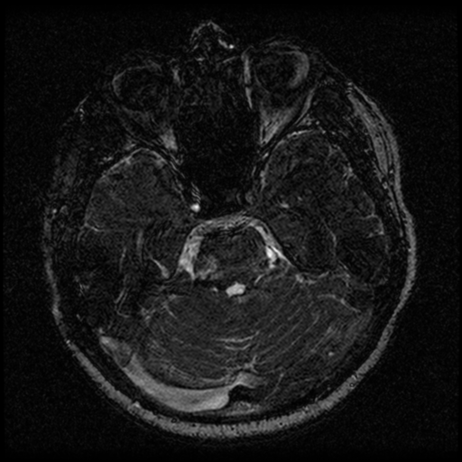 Acoustic schwannoma (Radiopaedia 33045-34060 Axial T2 57).png