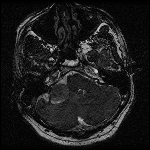 File:Acoustic schwannoma (Radiopaedia 39170-41387 Axial FIESTA 53).png