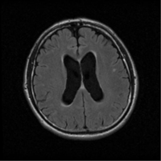 File:Acoustic schwannoma (Radiopaedia 39170-41387 Axial FLAIR 14).png