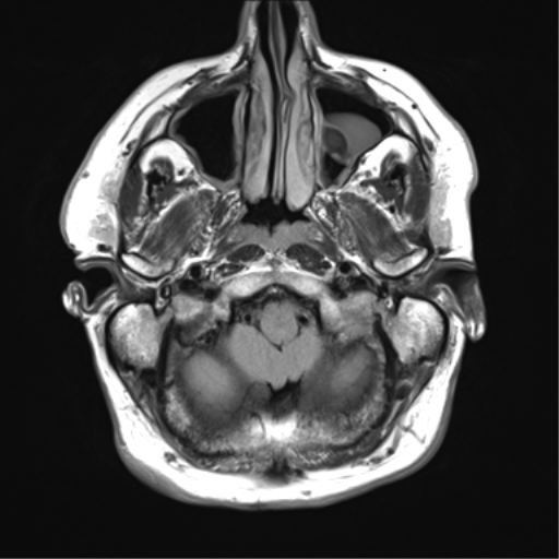 File:Acoustic schwannoma (Radiopaedia 50846-56358 Axial FLAIR 4).png