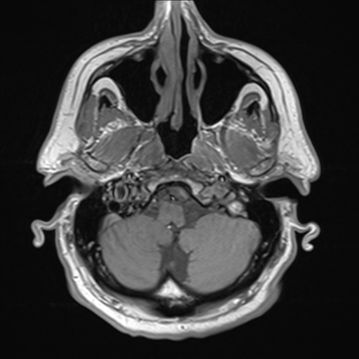 File:Acoustic schwannoma (Radiopaedia 55729-62281 T1 2).png