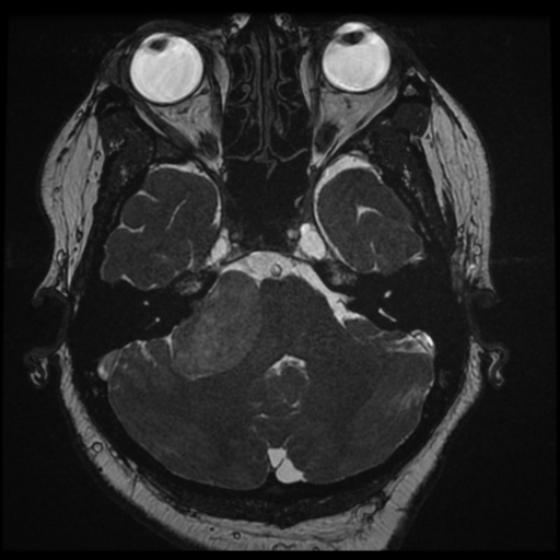 Acoustic schwannoma (Radiopaedia 57574-64536 Axial T2 36).png