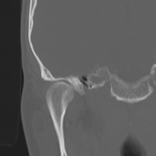 Acoustic schwannoma - eroding petrous apex (Radiopaedia 39674-42002 Coronal bone window 35).png