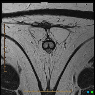 File:Acquired buried penis (Radiopaedia 39478-41797 Axial T2 23).jpg