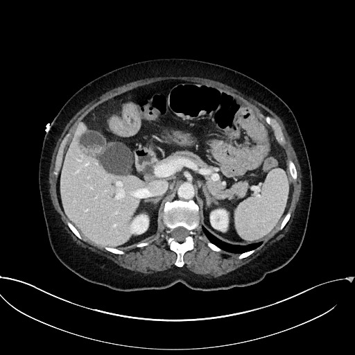 Active Crohn disease (Radiopaedia 59394-66750 Axial C+ portal venous phase 22).jpg