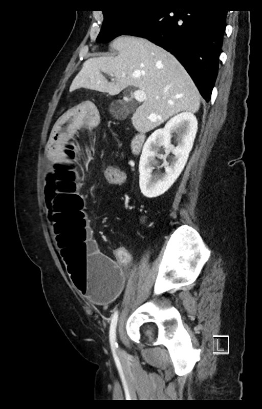 Active Crohn disease (Radiopaedia 59394-66750 Sagittal C+ portal venous phase 39).jpg