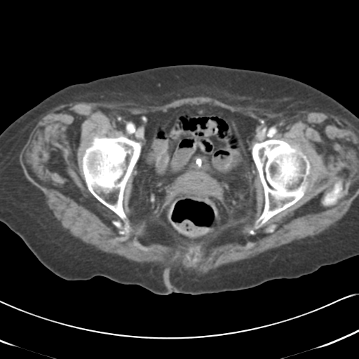 File:Active bleeding from duodenal ulcer with embolization (Radiopaedia 34216-35481 C 62).png