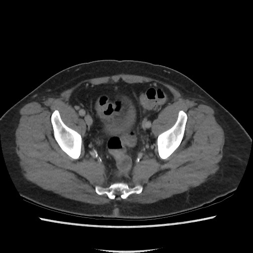 File:Active colonic bleed on CT (Radiopaedia 49765-55025 Axial C+ delayed 71).jpg