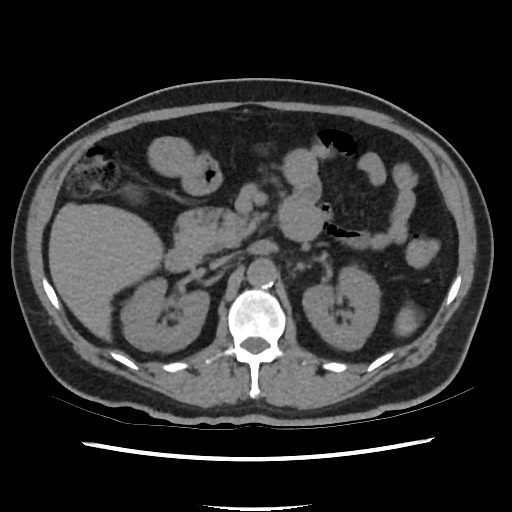 Active colonic bleed on CT (Radiopaedia 49765-55025 Axial non-contrast 28).jpg