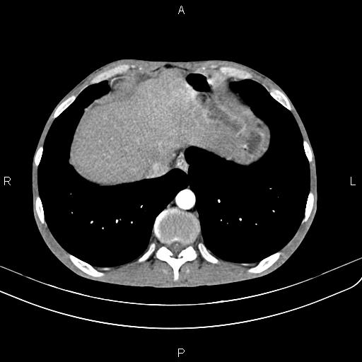 File:Active crohn disease (Radiopaedia 87133-103397 Axial C+ arterial phase 13).jpg