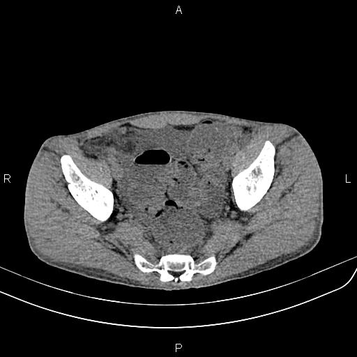 File:Active crohn disease (Radiopaedia 87133-103397 Axial non-contrast 87).jpg