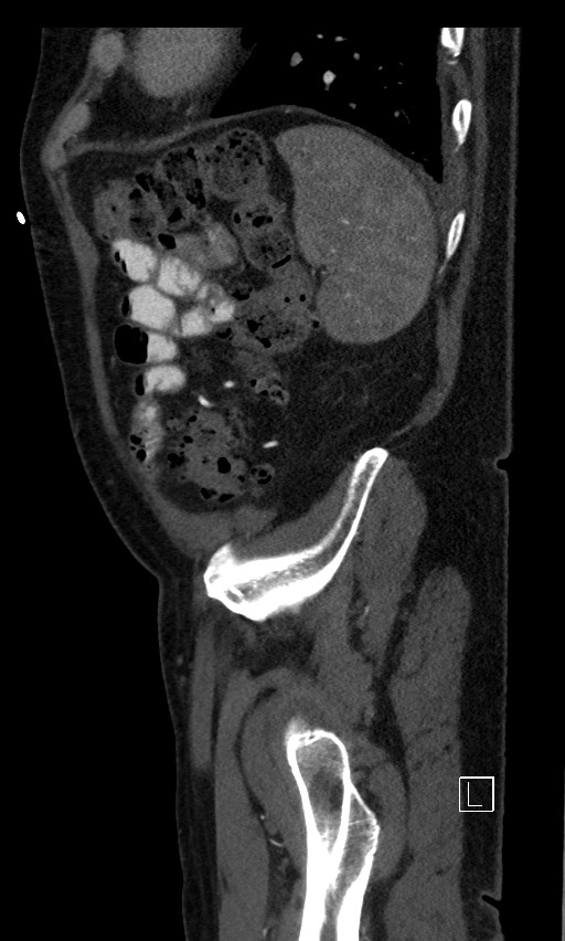Active lower gastrointestinal bleeding - diverticular (Radiopaedia 61203-69106 Sagittal C+ arterial phase 26).jpg
