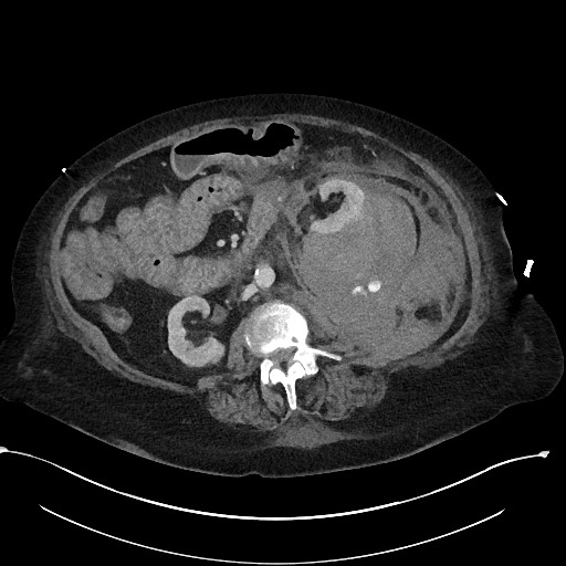 File:Active renal extravasation with large subcapsular and retroperitoneal hemorrhage (Radiopaedia 60975-68796 Axial 251).jpg